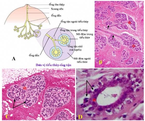 Ca lâm sàng: Ung thư biểu mô nội ống tuyến vú