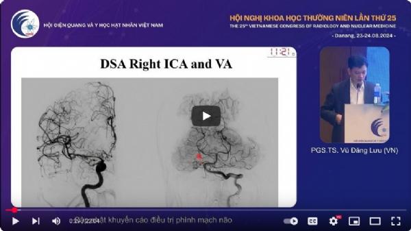 Cập nhật khuyến cáo điều trị phình mạch não